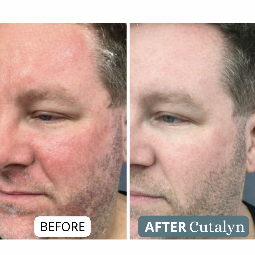 Cutalyn® Cream | Gently Soothes and Softens Scalp and Skin
