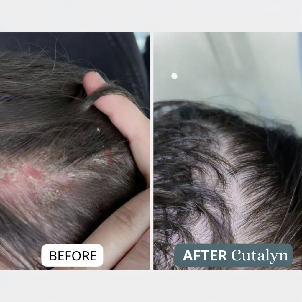 Cutalyn® Cream | Gently Soothes and Softens Scalp and Skin