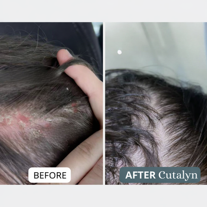 Cutalyn® Cream | Gently Soothes and Softens Scalp and Skin