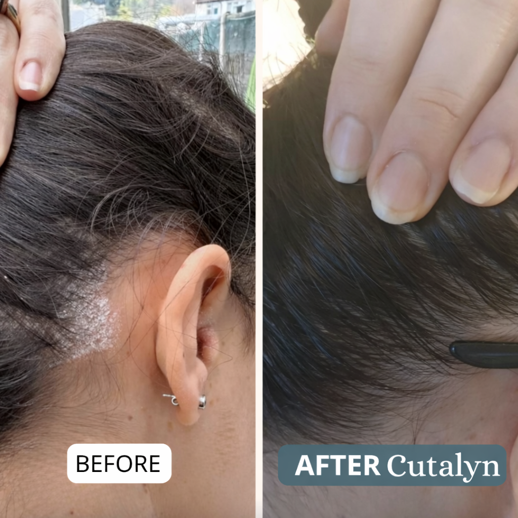 Cutalyn® Cream | Gently Soothes and Softens Scalp and Skin